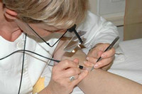 электроэпиляция 